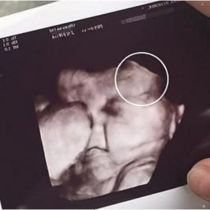 Mother Feared the Worst After Seeing Her Daughter’s Ultrasound — But Relief Followed