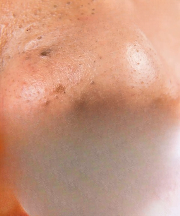 Can Vaseline Help Remove Blackheads? A Closer Look at the “Vaseline + Oil Cleansing” Method