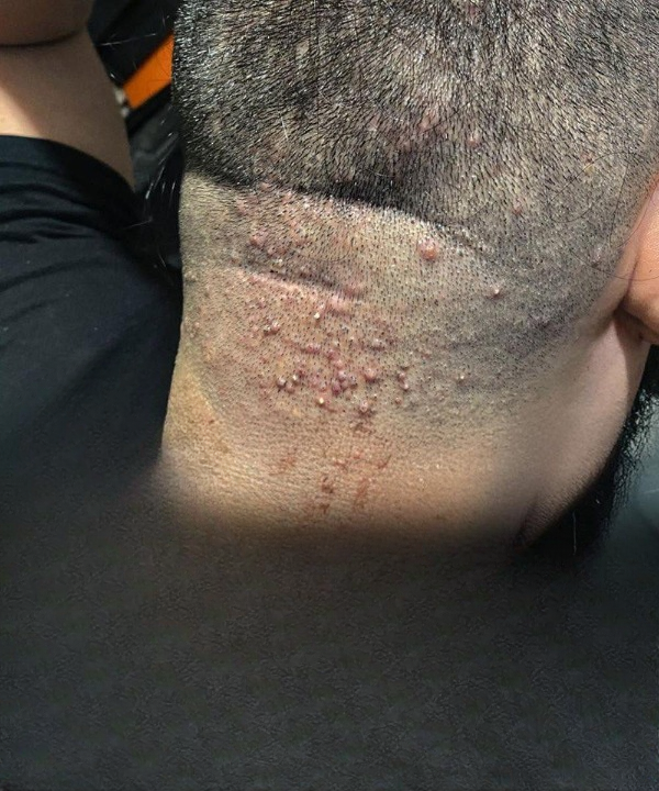 Hair Salon Alert: A Common Skin Infection After a Haircut and How to Prevent It