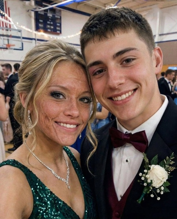 A Boy Asked Me to Dance at Prom Because No One Else Would Due to My Scars—The Next Day, His Parents and Officers Showed Up at My Door