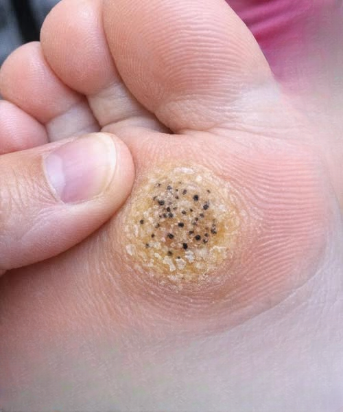 My Daughter Has a Painful Spot on Her Foot Before Her Dance Recital — What Can I Do Fast?