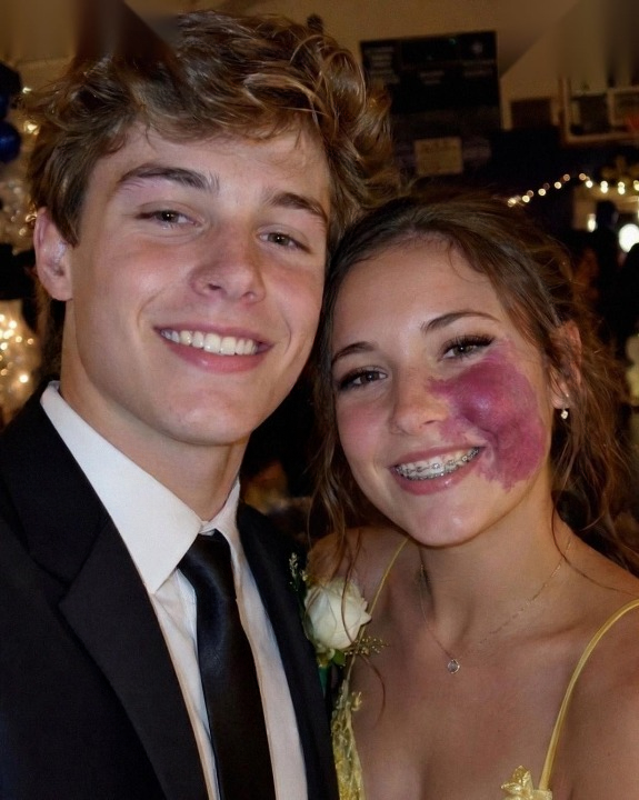Only One Boy Asked Me to Prom Because of the Birthmark on My Face — Then a Police Officer Walked Into the Gym and Changed Everything