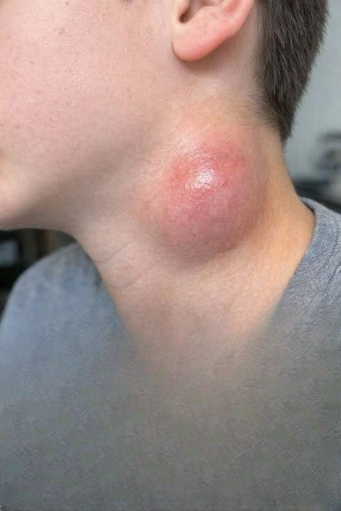 Shocking Discovery of a Sudden Neck Lump Sends Parents Into Panic Mode — Here’s What You Actually Need to Know